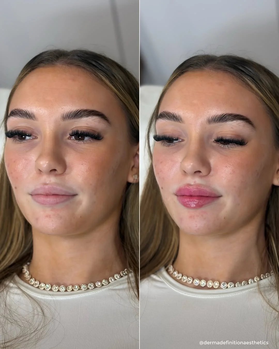 Microneedling before and after results