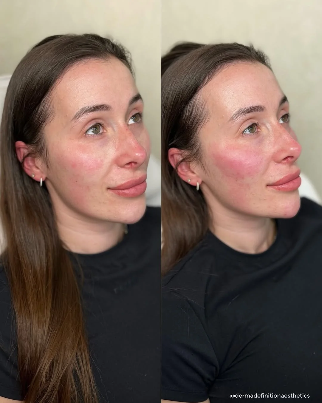 Subtle facial balancing results