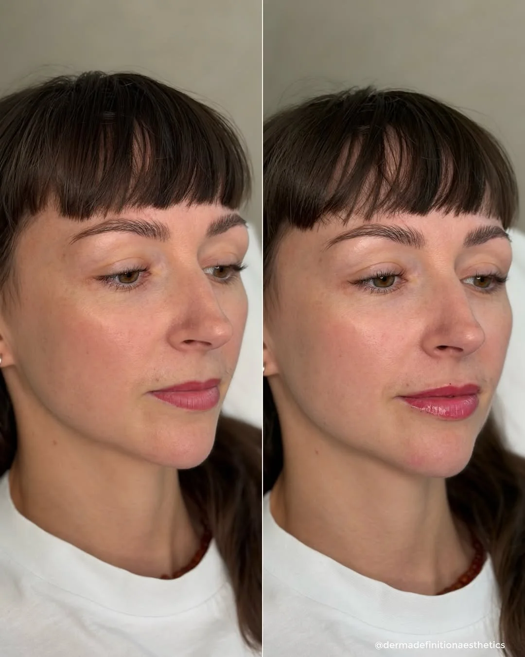 Skin booster before and after treatment