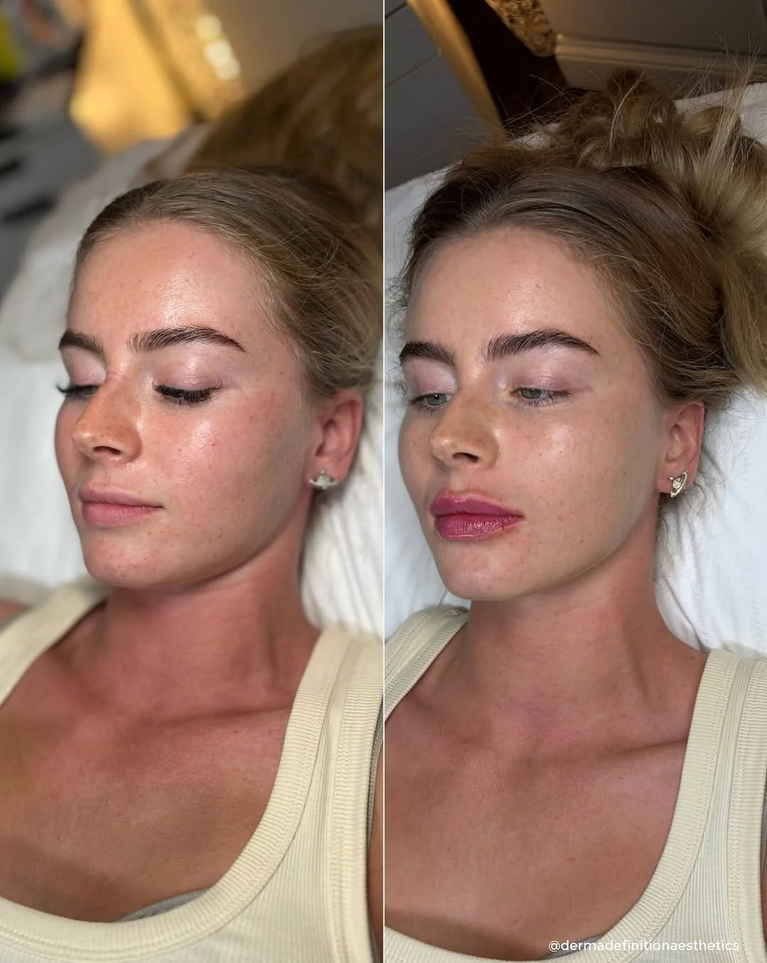 Natural lip enhancement transformation