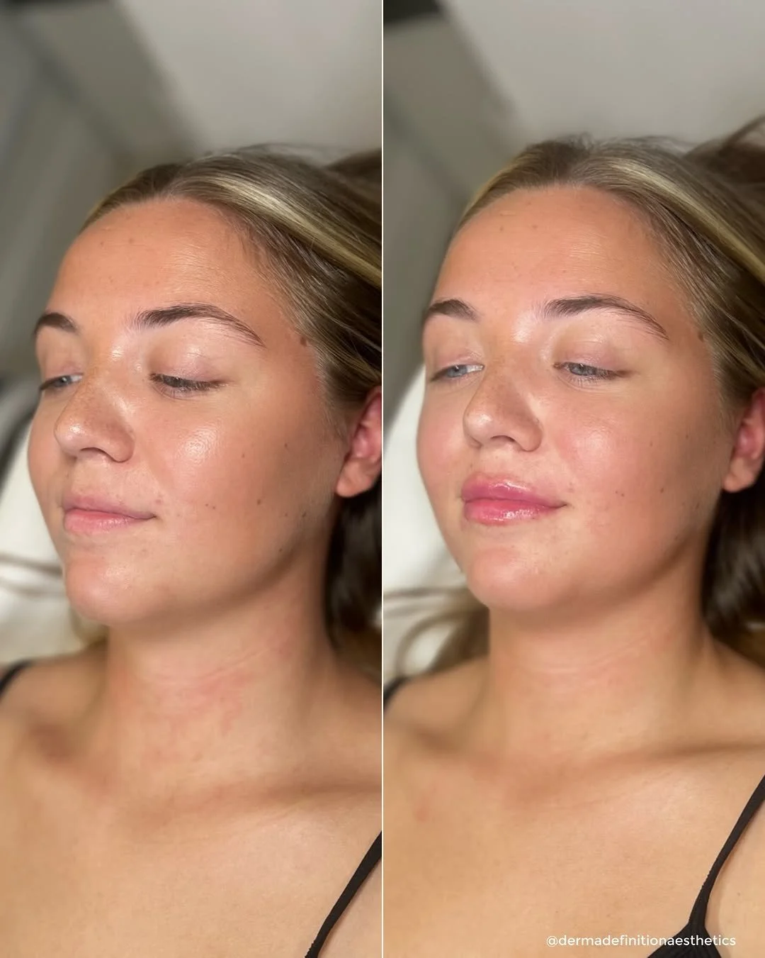 Lip filler before and after results