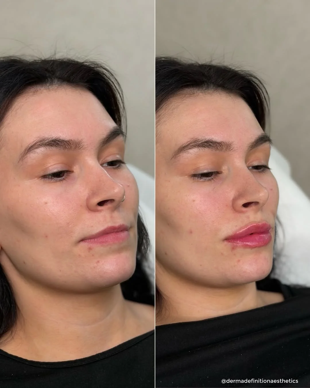 Anti-wrinkle treatment before and after