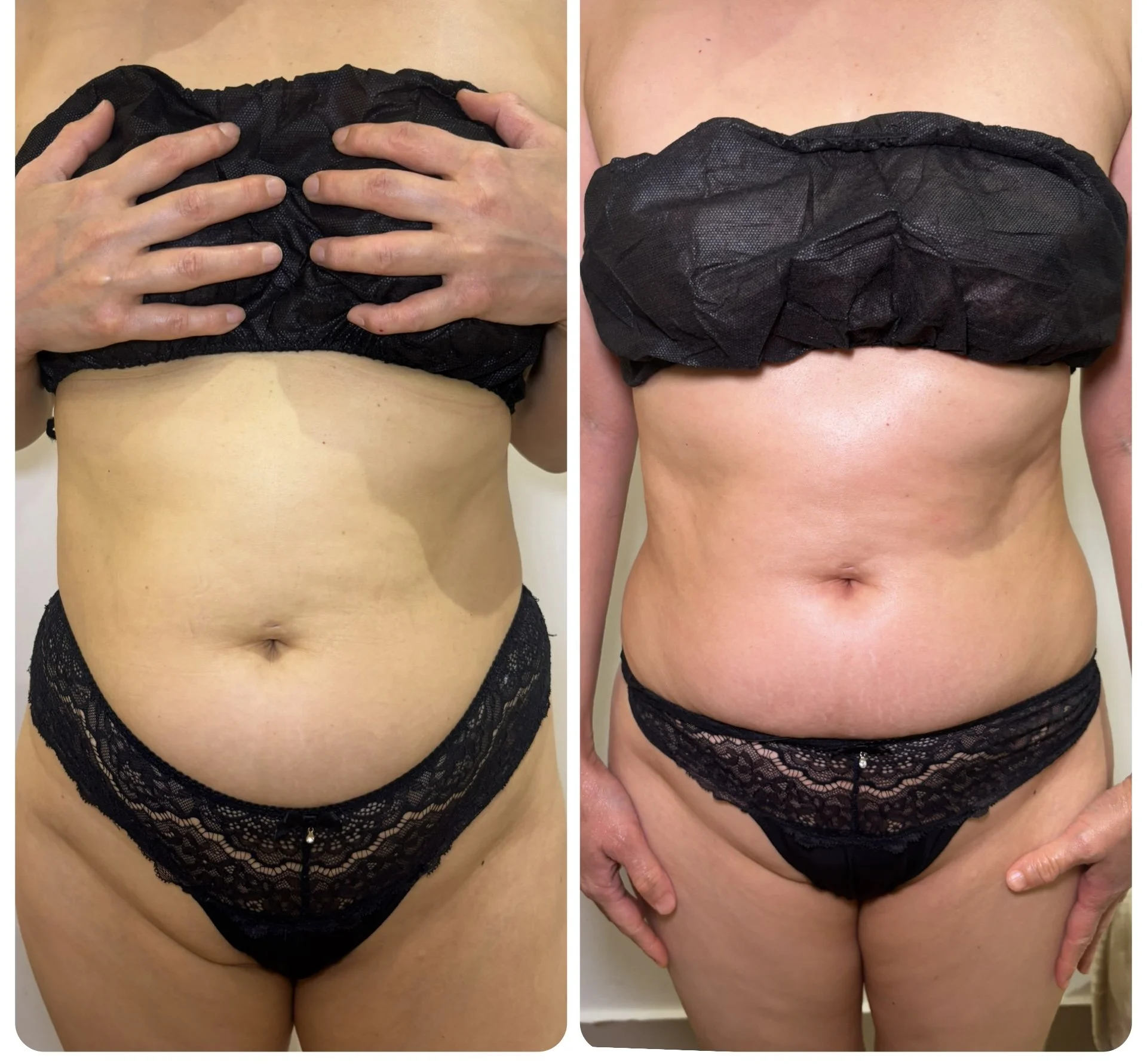 Comparison of a woman's abdominal area before and after a procedure, showing improved skin tone and texture. The woman is wearing black lace underwear, with hands in the before image.