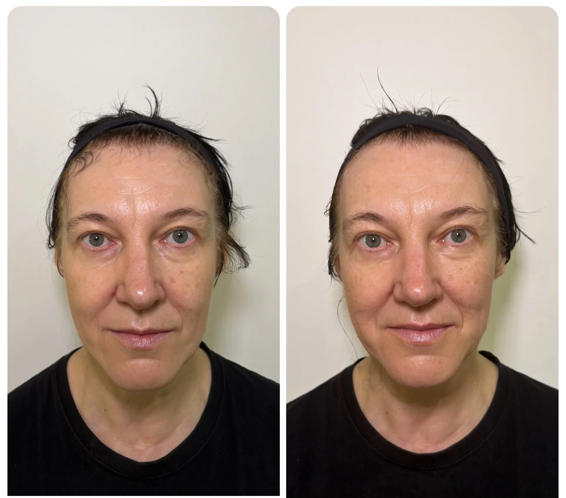 Comparison of a woman's face showing before and after treated with a skincare procedure, focusing on forehead, eyes, and skin texture, with a black headband and black shirt.