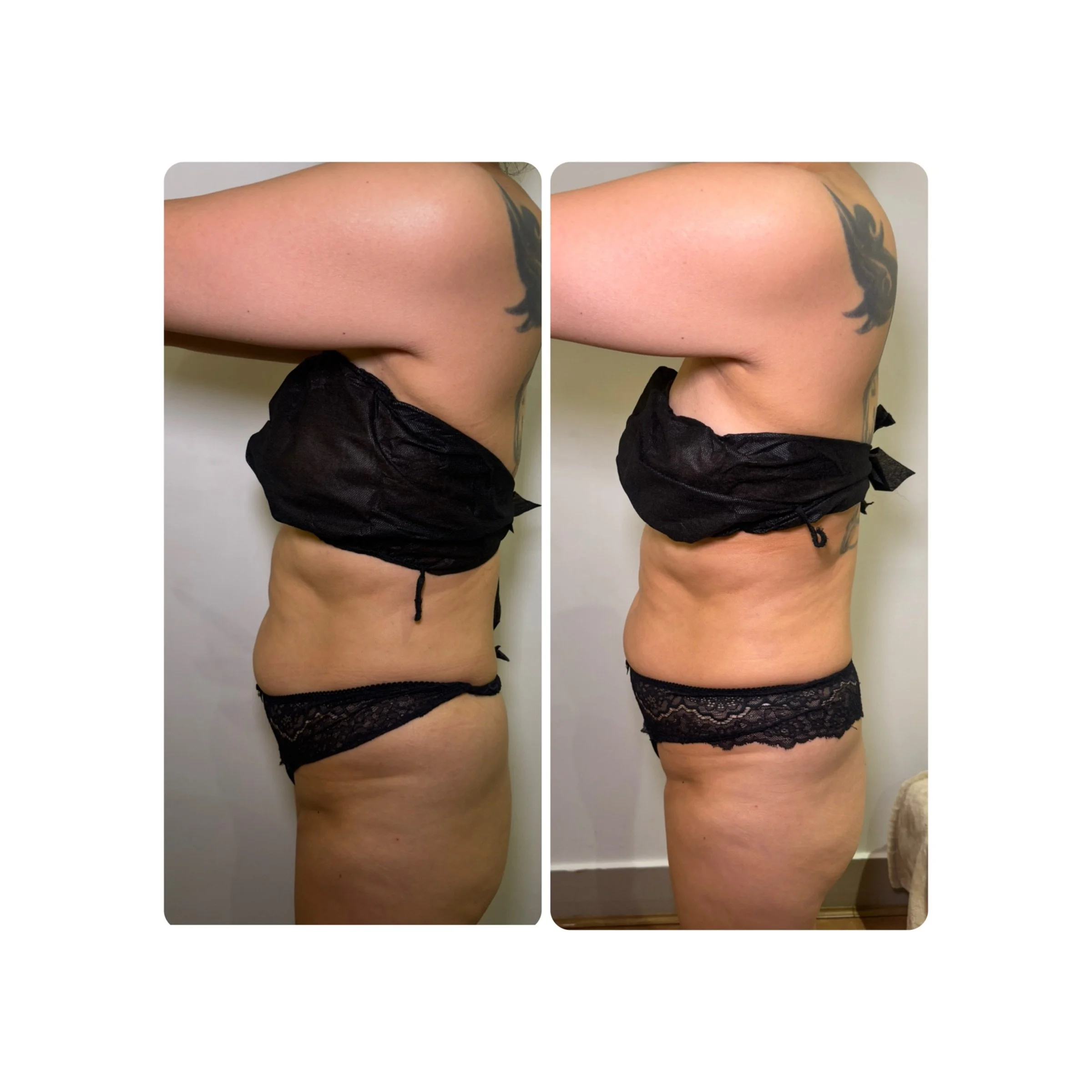 A side-by-side comparison of a person's side torso and upper thigh before and after a treatment, showing slight skin tightening and contouring.