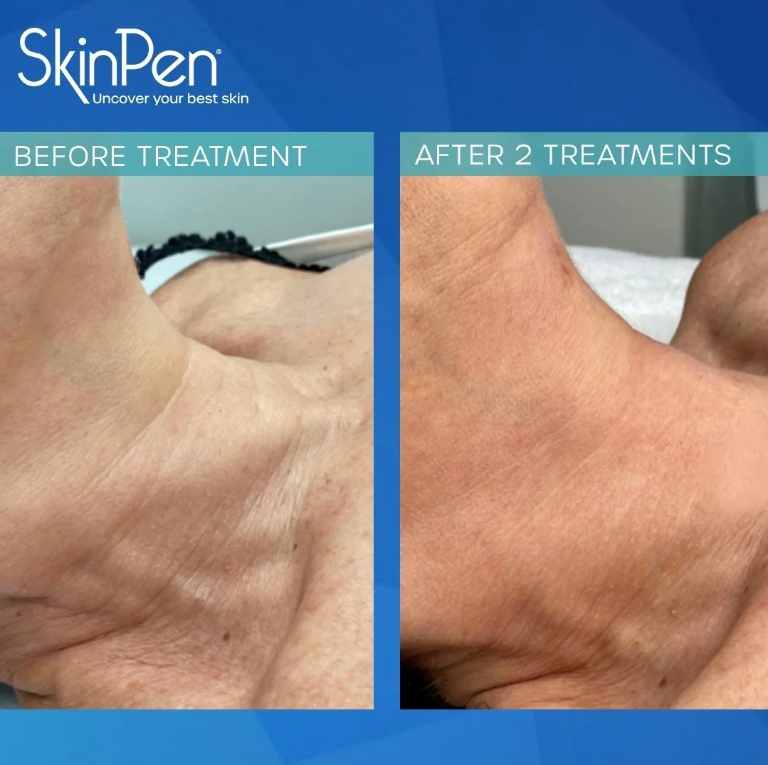 Comparison of skin on neck before and after two treatments, showing improved skin texture and appearance.