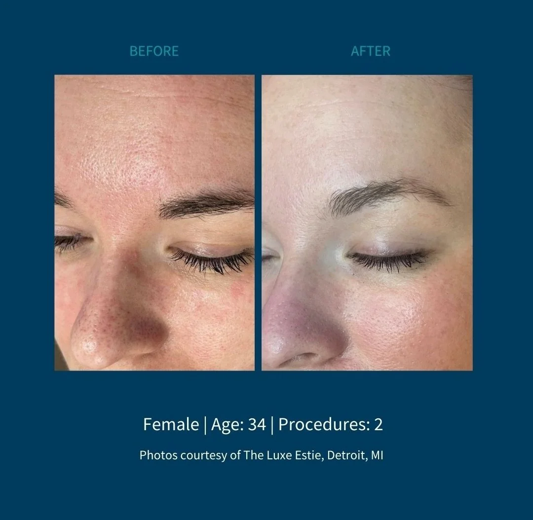 Before and after images showing skin improvement on a woman's face, focusing on forehead and cheek area, with text indicating it is a skincare procedure comparison for a 34-year-old female with two procedures, credited to The Luxe Estie, Detroit, MI.
