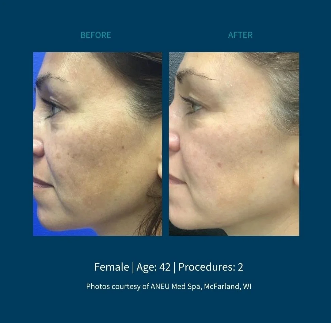 Before and after photos of a 42-year-old woman showing improved skin texture and reduced hyperpigmentation after two dermatological procedures, taken at ANEU Med Spa in McFarland, Wisconsin.
