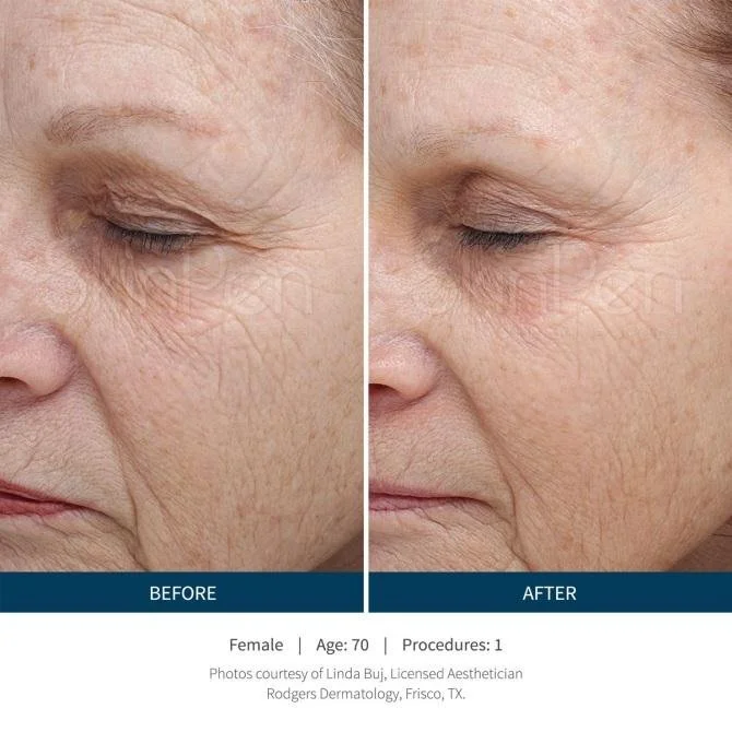 Close-up of a 70-year-old woman's face showing a side-by-side comparison of skin appearance before and after a cosmetic procedure. The 'before' side shows more wrinkles and sagging, while the 'after' side appears smoother with fewer wrinkles.