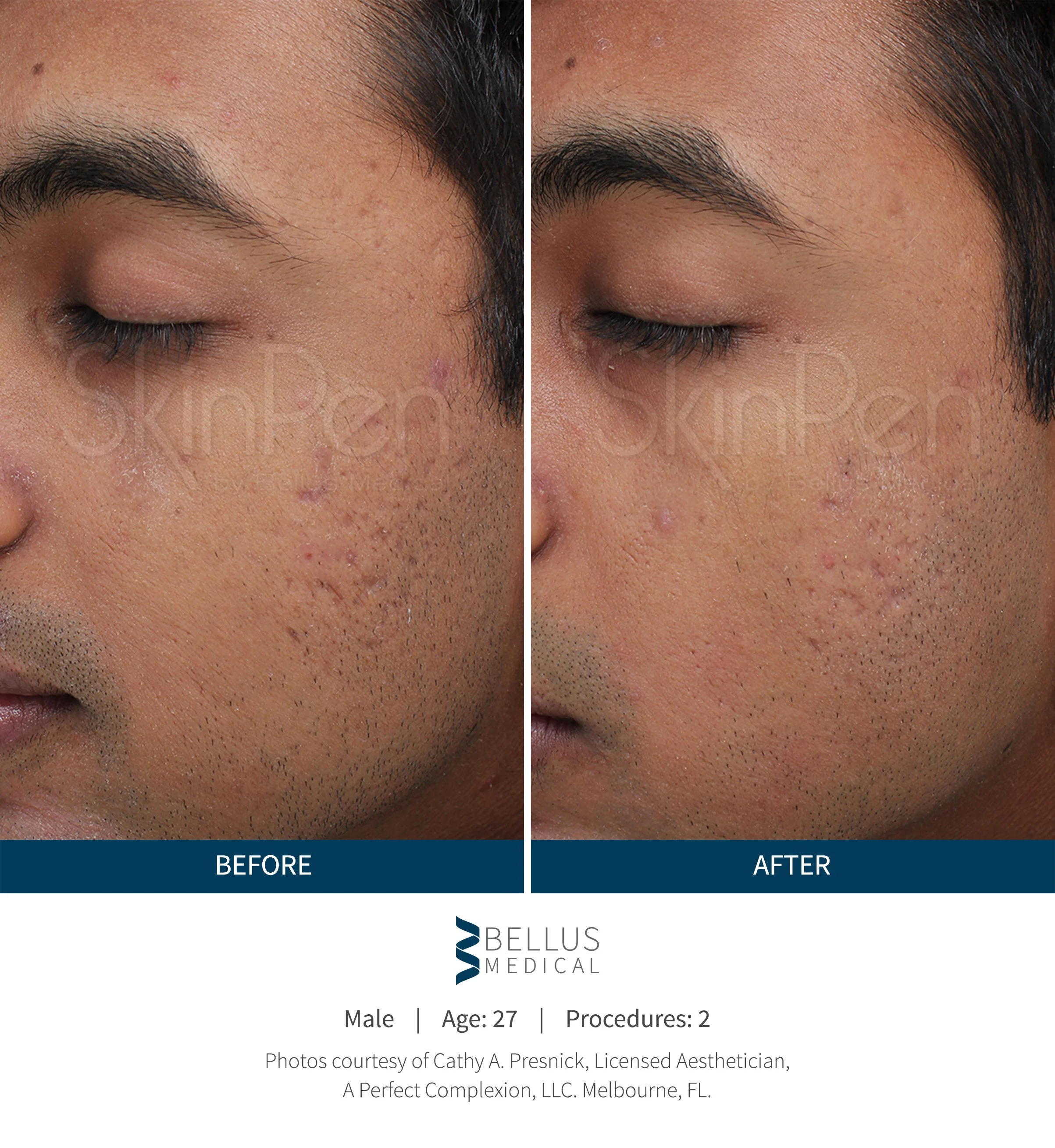 Side-by-side comparison of a man's face showing skin blemish before and after skincare treatment, with text indicating the procedure was performed by Bellus Medical.