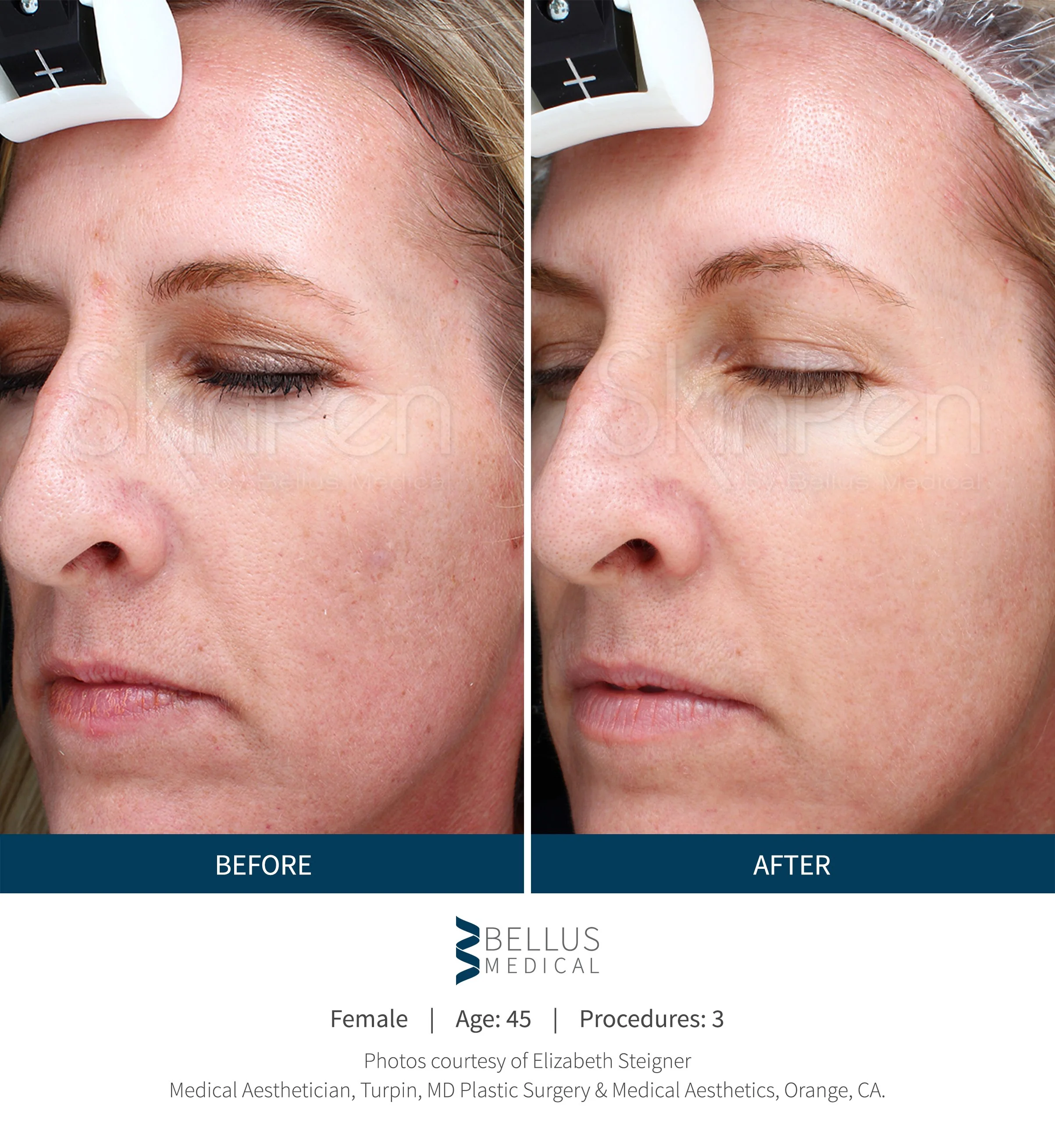 Close-up of a woman's face showing before and after skincare or cosmetic procedure results, highlighting improved skin texture and clarity.