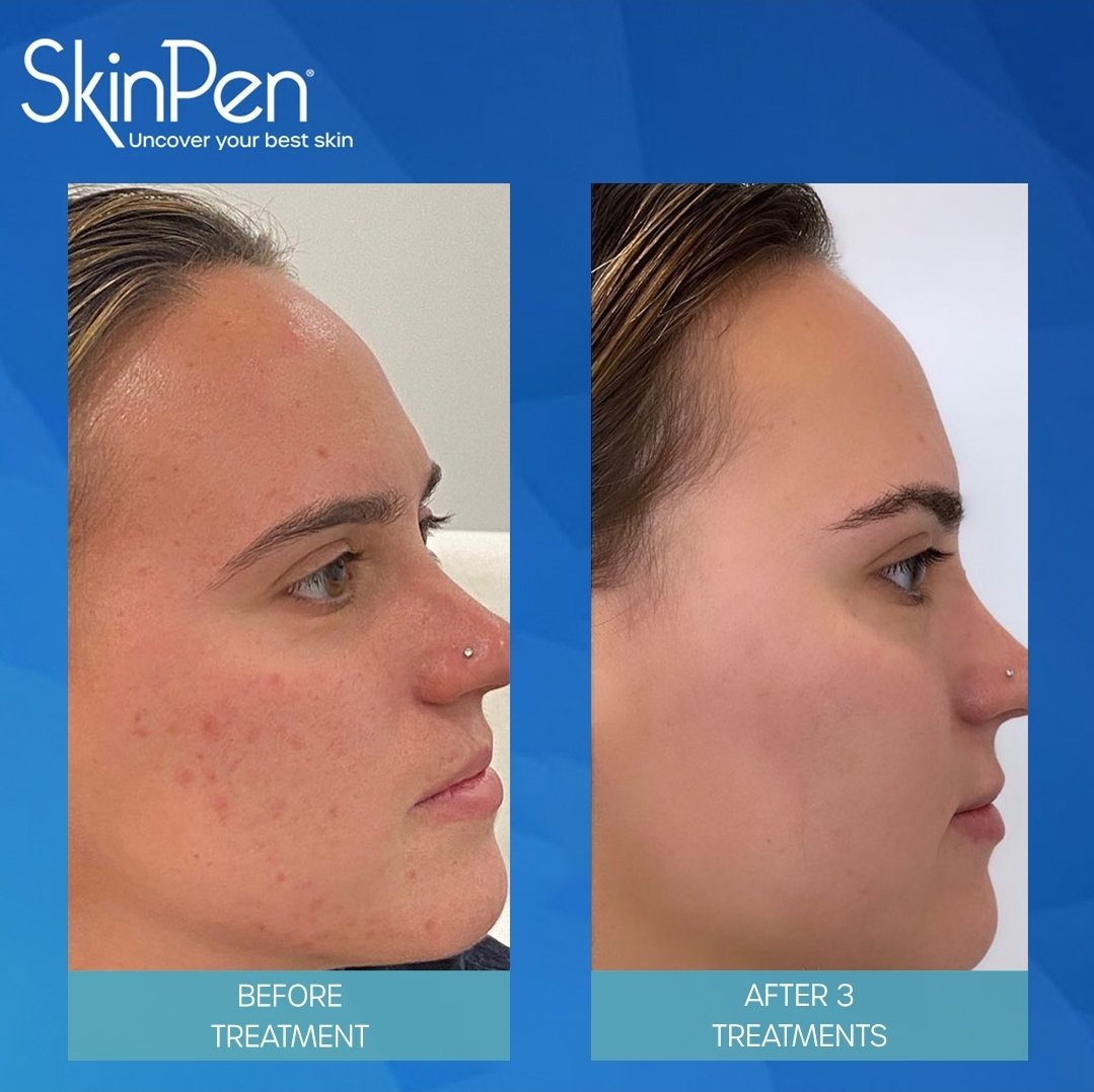 Side-by-side comparison of a woman's face showing skin improvement. The left side labeled 'Before Treatment' shows acne and redness, while the right side labeled 'After 3 Treatments' shows clear skin.