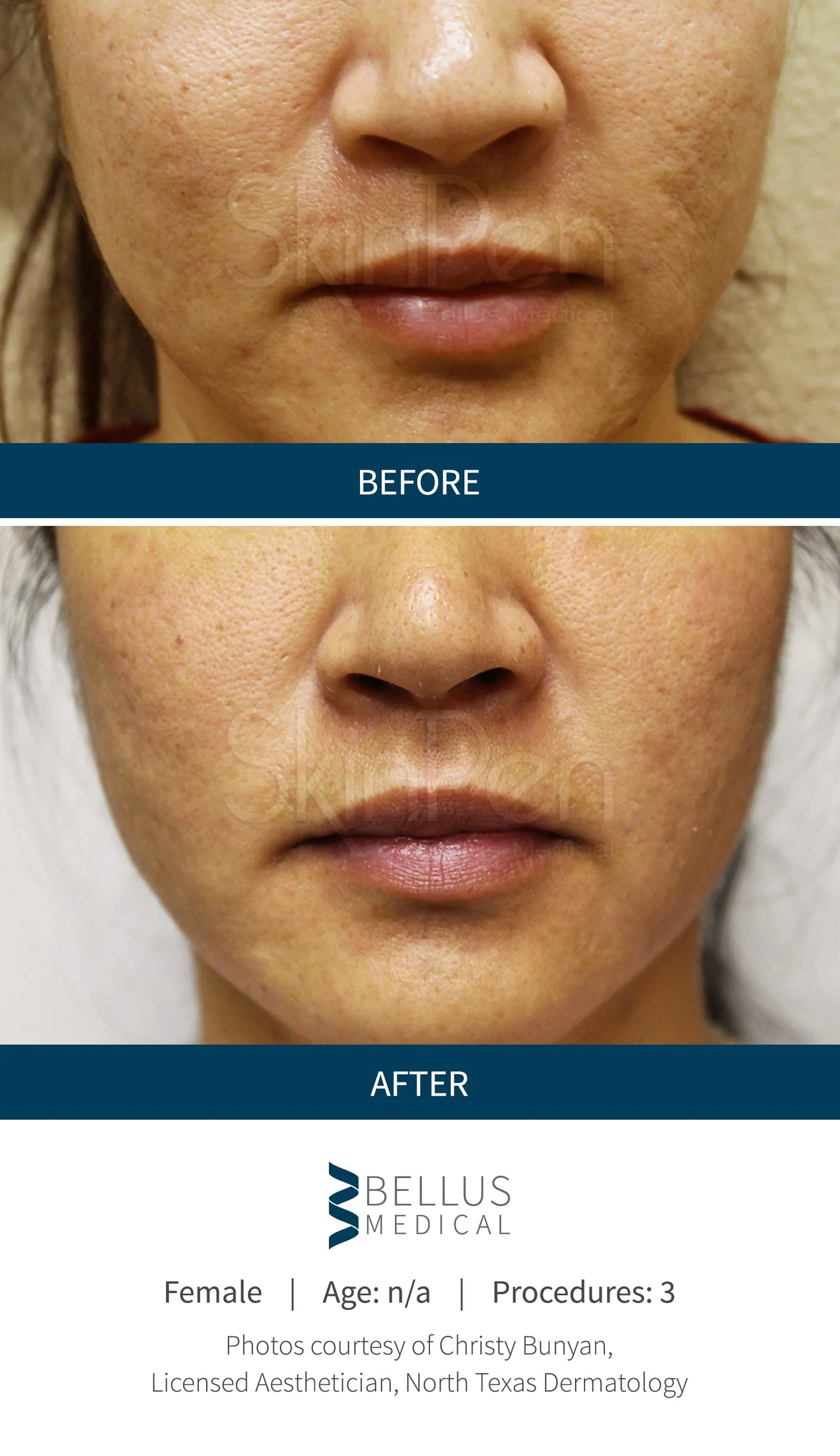 Close-up of a woman's face showing before and after skin treatment results, with improved skin texture and reduced pores. The top image is labeled 'BEFORE,' and the bottom is labeled 'AFTER.'