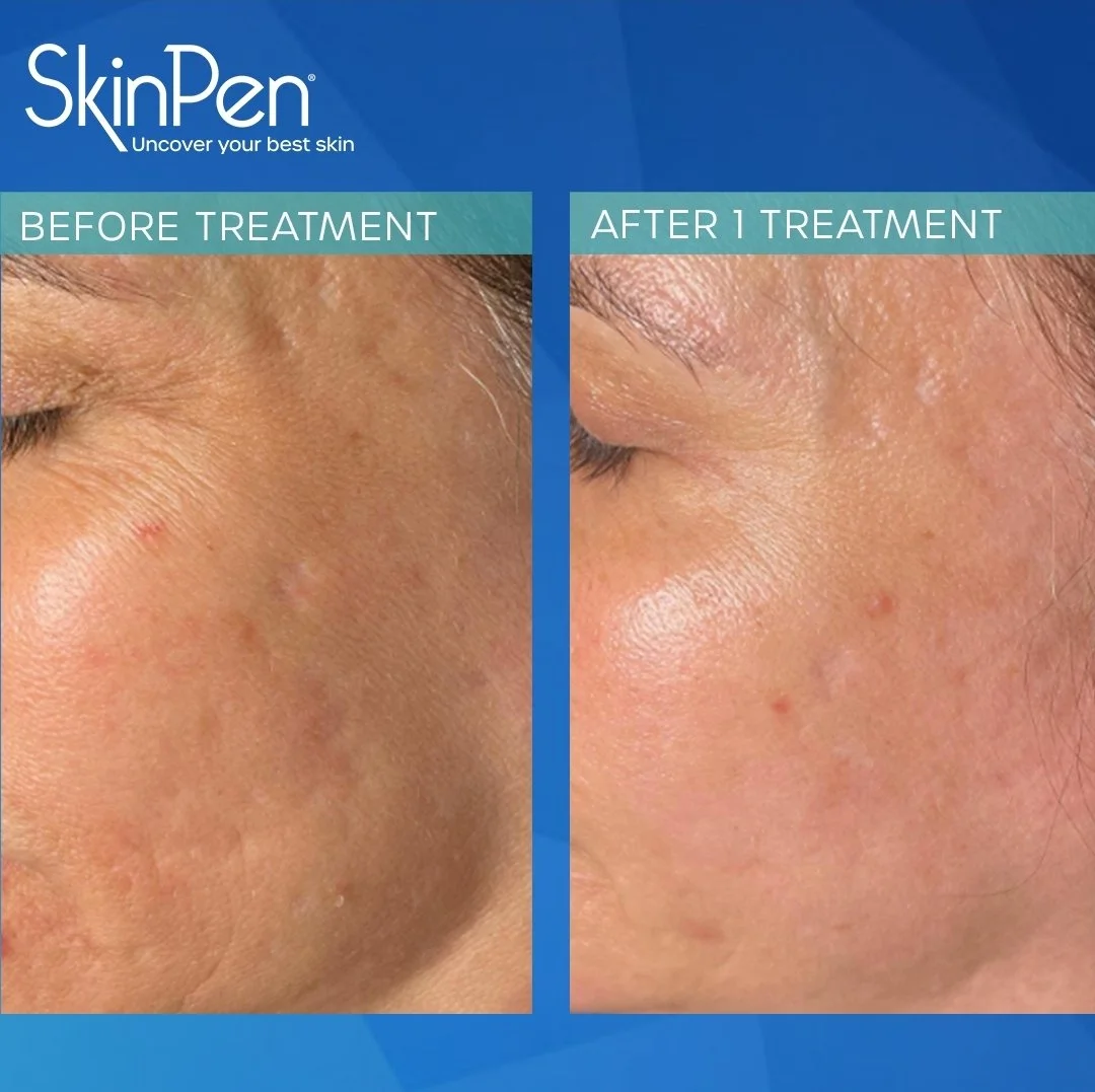Close-up comparison of facial skin before and after treatment, showing improved skin clarity and reduced blemishes.