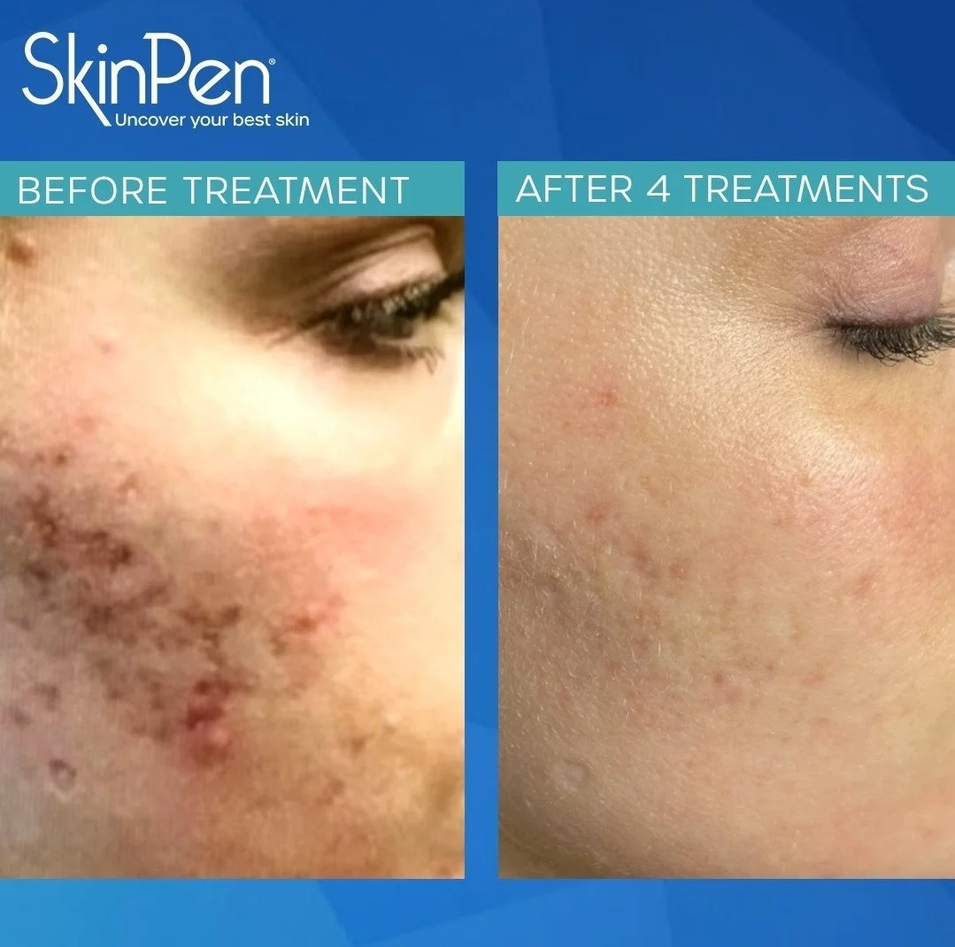 Comparison of skin condition before and after four treatments, showing improvement in skin clarity and reduction of acne scars.
