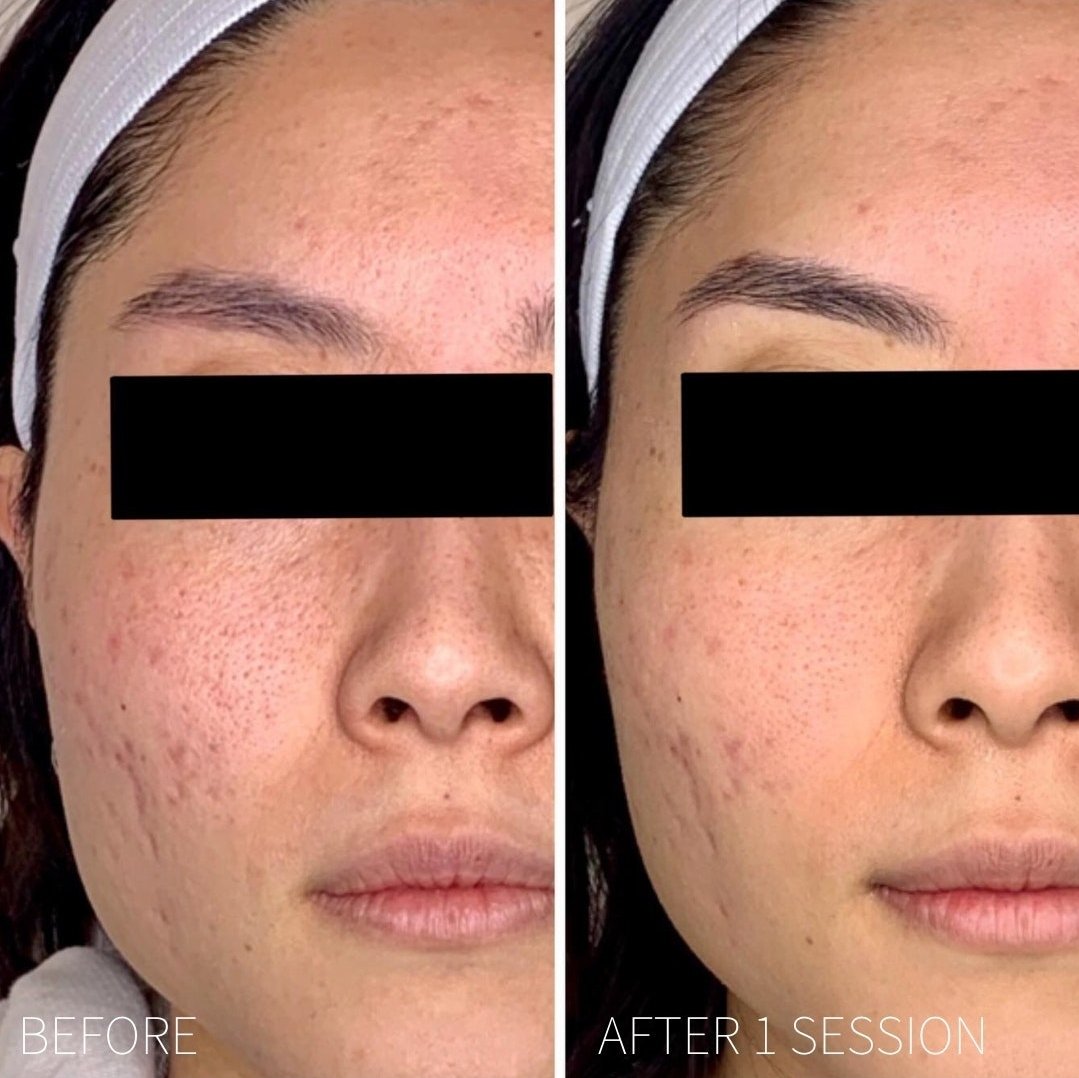 Side-by-side comparison of a woman's face showing improved skin condition after one session; left side labeled 'BEFORE' with acne scars and redness, right side labeled 'AFTER 1 SESSION' with clearer skin.