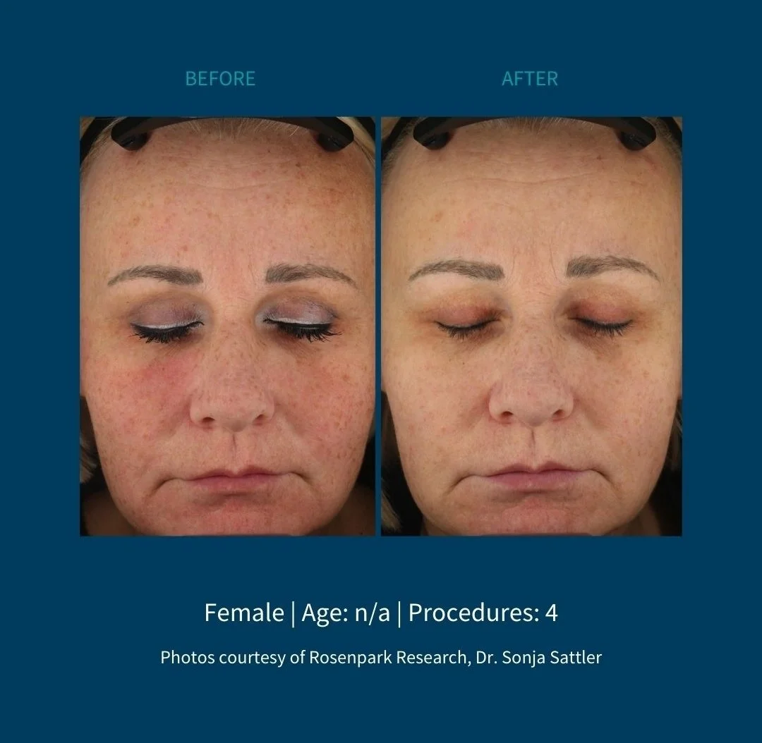 Before and after skincare treatment showing a woman's face with reduced redness and improved skin tone.