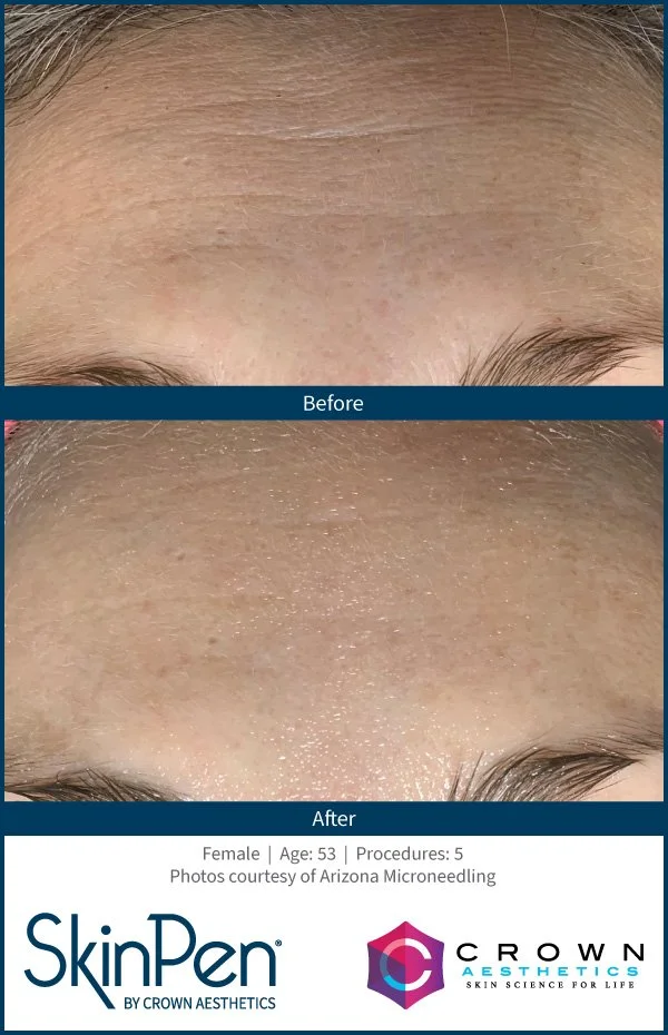 Close-up of a woman's forehead before and after skincare treatment, showing improved skin texture.