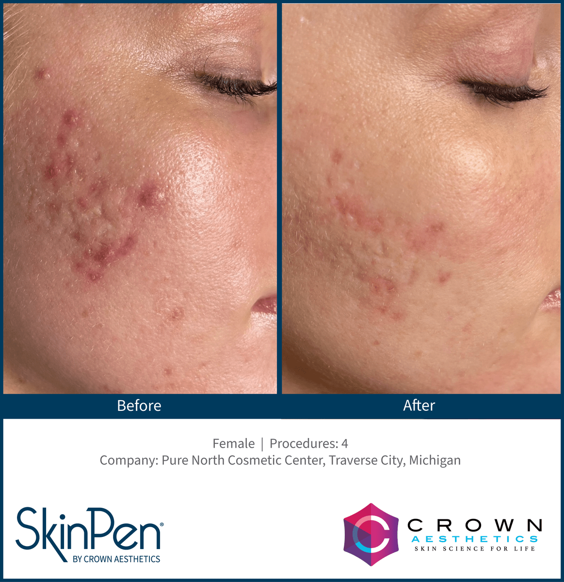 Side-by-side comparison of a woman's cheek before and after skincare treatment showing reduction in acne scars and redness.