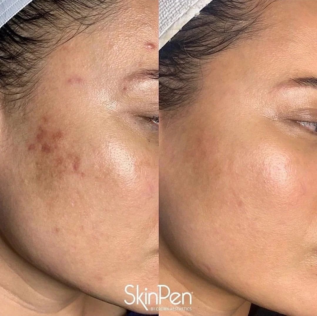 Side-by-side comparison of a woman's cheek showing skin improvement, with visible acne scars on the left and clear skin on the right.