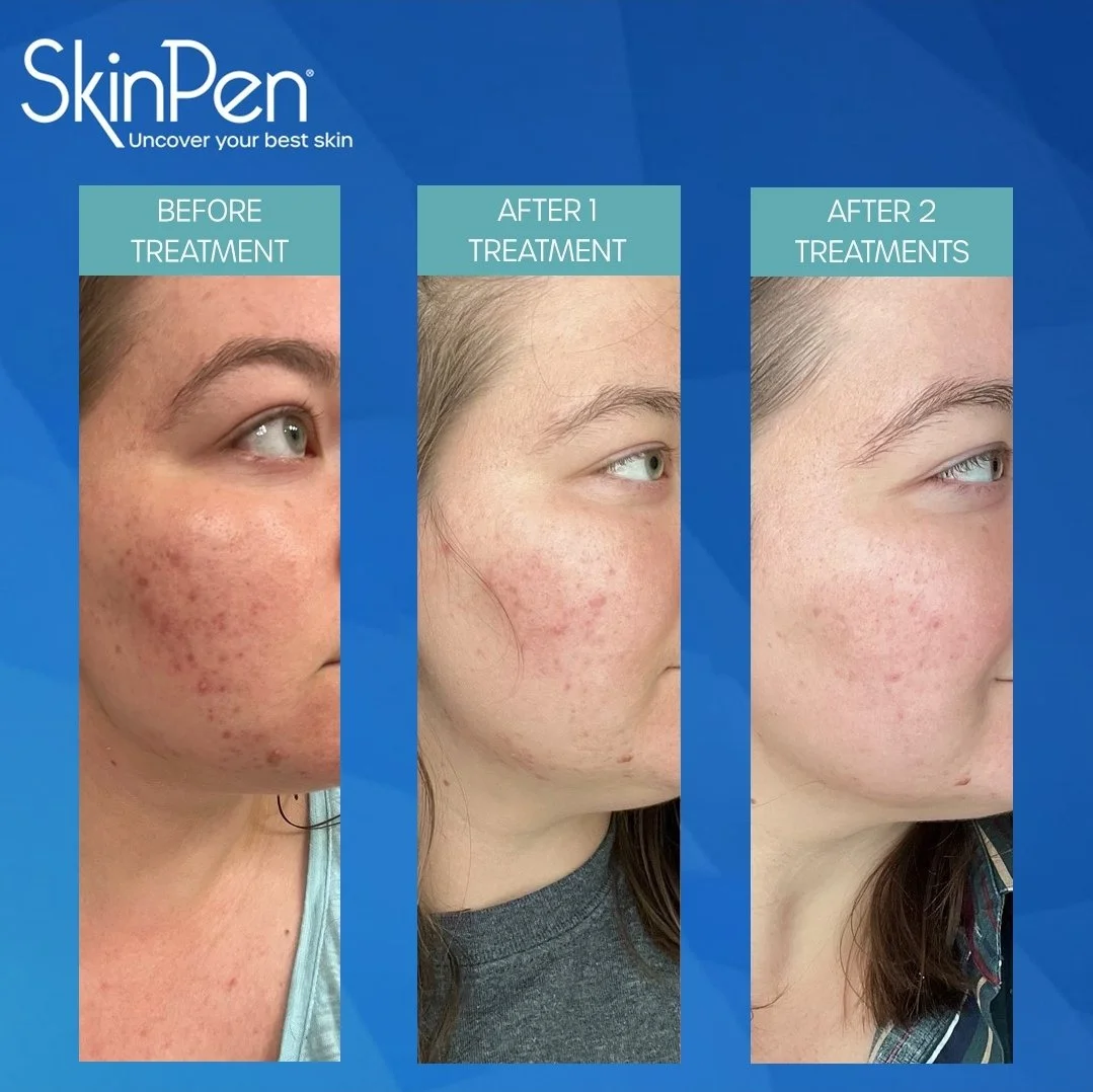 Chronological sequence showing skin improvement with treatments. The first image shows skin with acne scars and redness before treatment. The second image shows reduced redness and scars after one treatment. The third image shows further skin improve