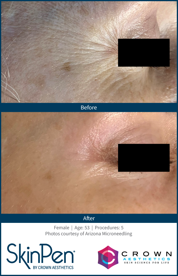 Close-up of a woman's eye area showing a before-and-after comparison of skin treatment, with improved skin texture and reduced pigmentation in the after image.