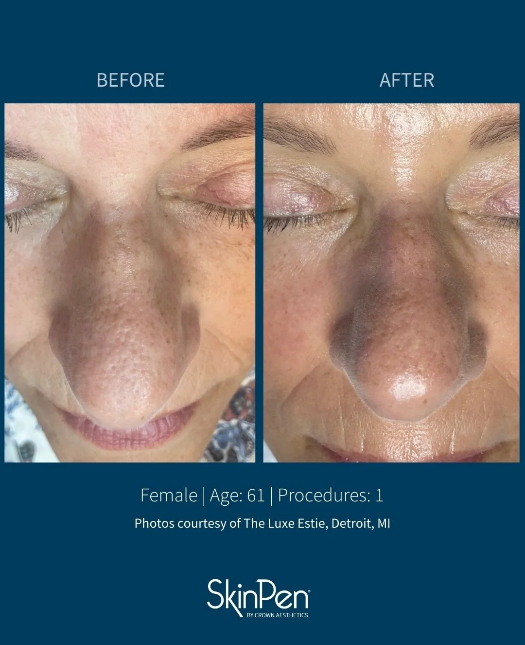 Side-by-side comparison of a woman's nose before and after a cosmetic procedure, highlighting improved skin texture and appearance.