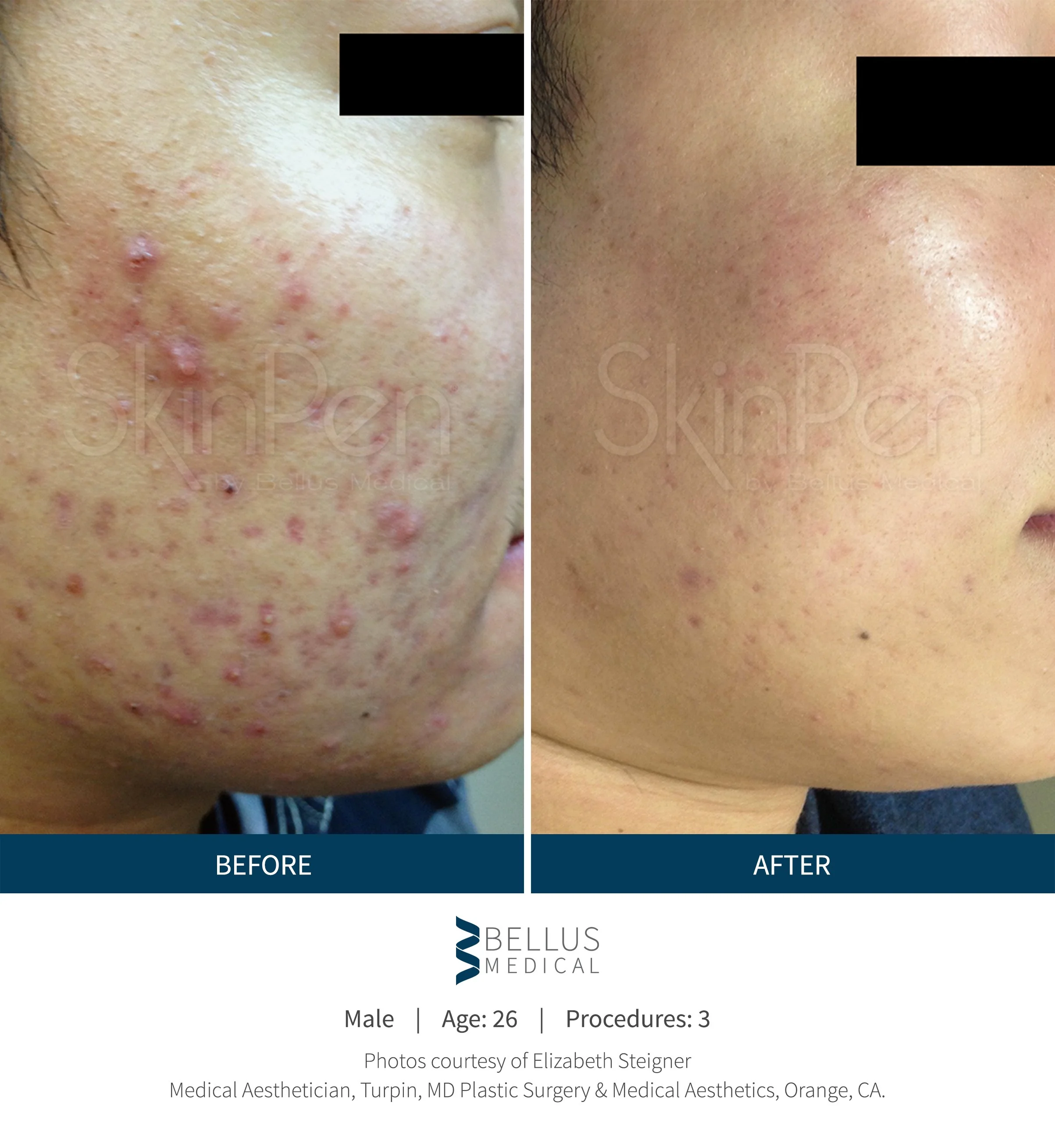 Before and after images showing improvement in skin condition with fewer acne lesions and smoother skin after treatment.