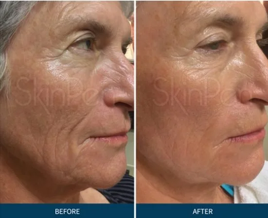 Side-by-side comparison of a woman's face showing before and after skin treatment, with visible reduction in wrinkles and improved skin texture