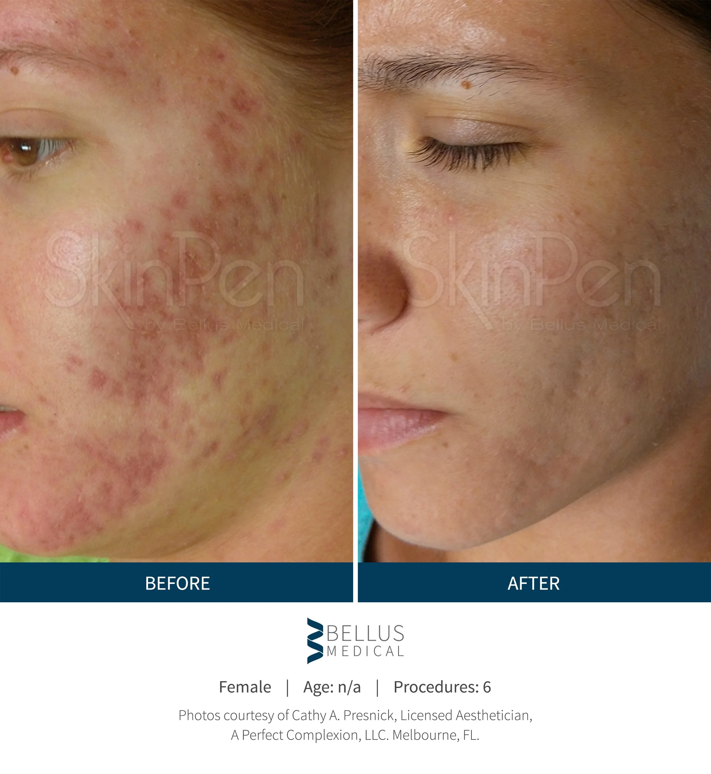 Before and after comparison images of a person's facial skin showing improvement in skin condition after six procedures. The before image displays red, inflamed, and acne-prone skin, while the after image shows clearer and smoother skin.