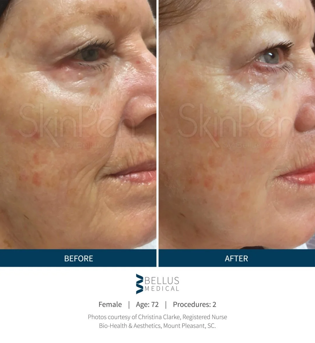 Side-by-side comparison of a 72-year-old woman's face showing improved skin in the after photo, with less redness and wrinkles, following two medical procedures.