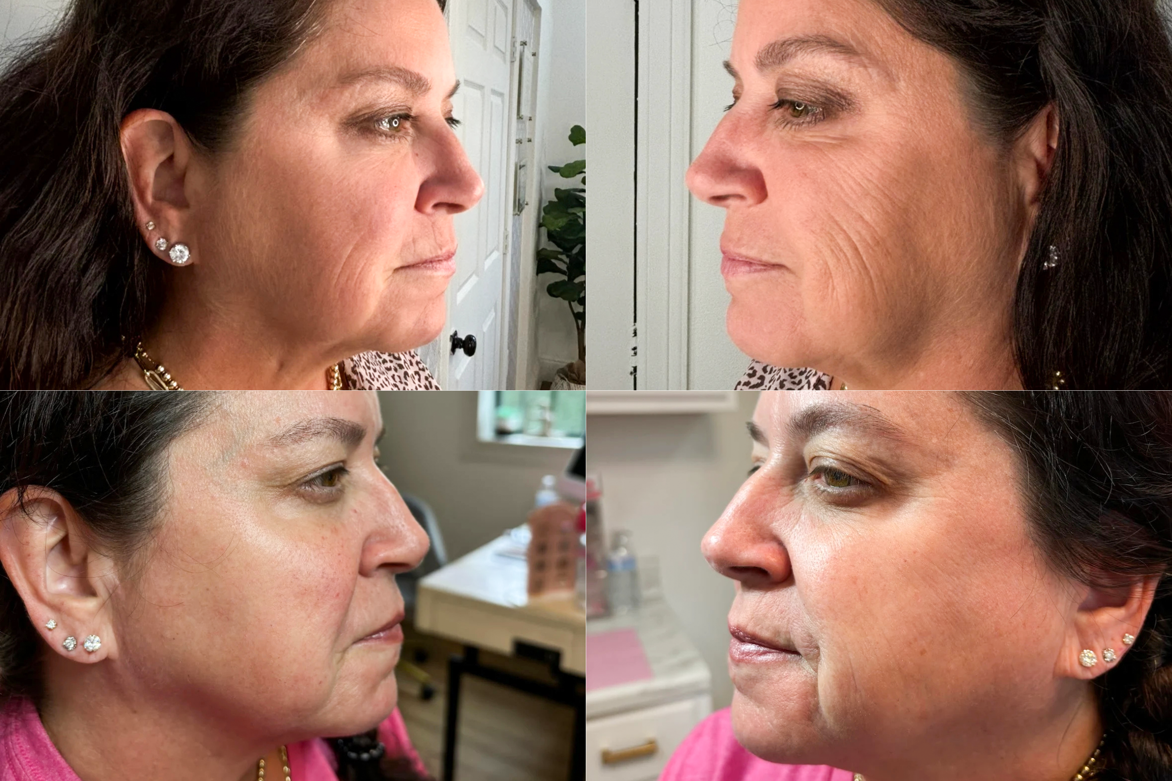 Collage of four close-up profile photos of a middle-aged woman with dark hair, wearing earrings and a pink top, showing her face before and after a cosmetic procedure.