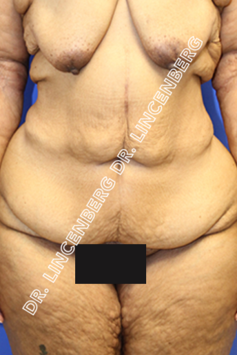 Close-up of an older woman's torso and hips, showing skin folds and sagging skin, with black censor block over pelvic area.