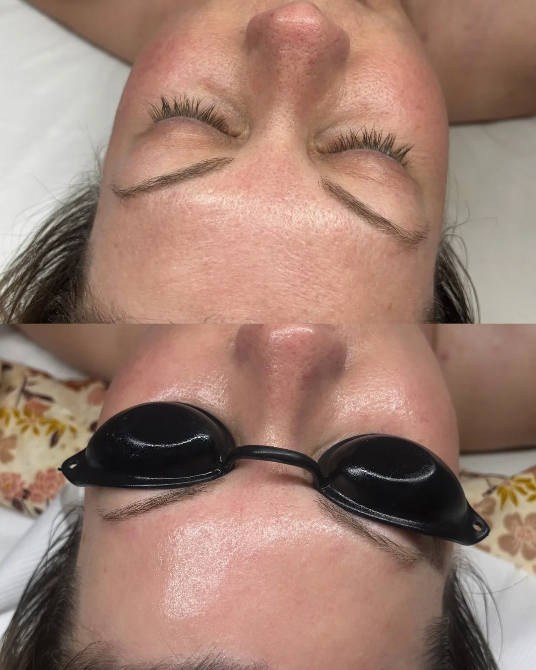 CO2Lift Pro + red light therapy 🫧
45 minutes later and the skin looks calmer, smoother, and more hydrated! 

This treatment helps improve pore appearance, fine lines and wrinkles, texture, redness, inflammation, and puffiness while deeply hydrating 