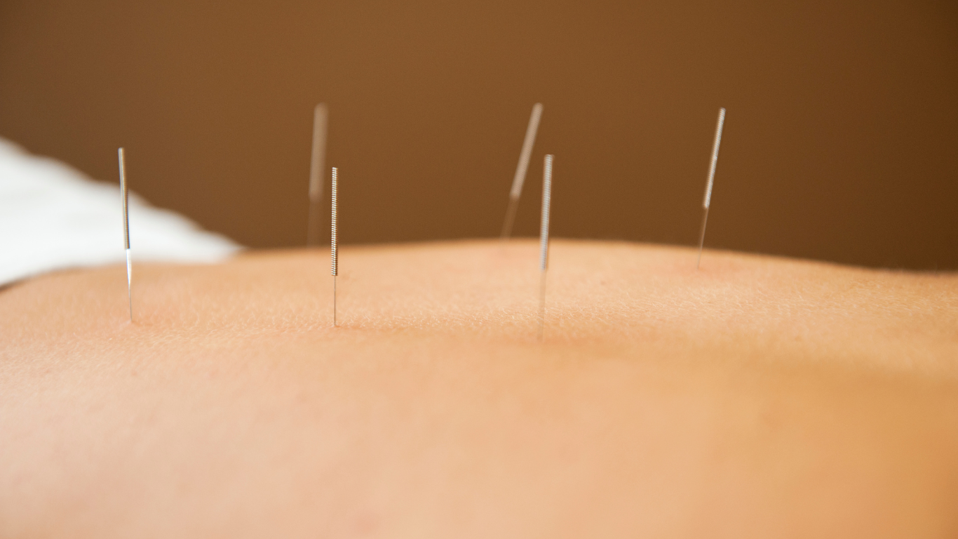 Vantage Point Physiotherapy & Sports Medicine provide dry needling services in Bondi Junction.