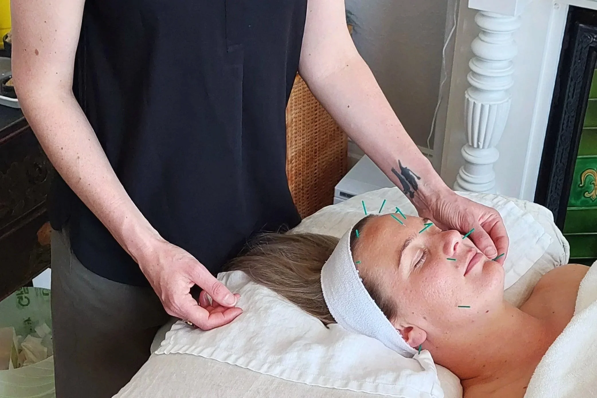 Relaxed person receiving facial acupuncture