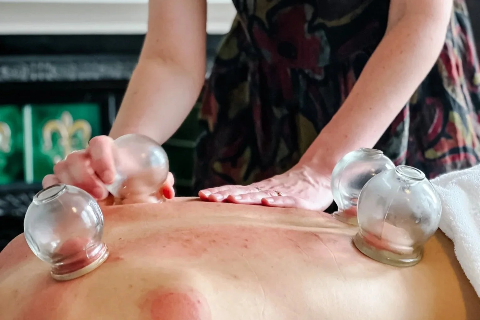 Patient receiving cupping therapy