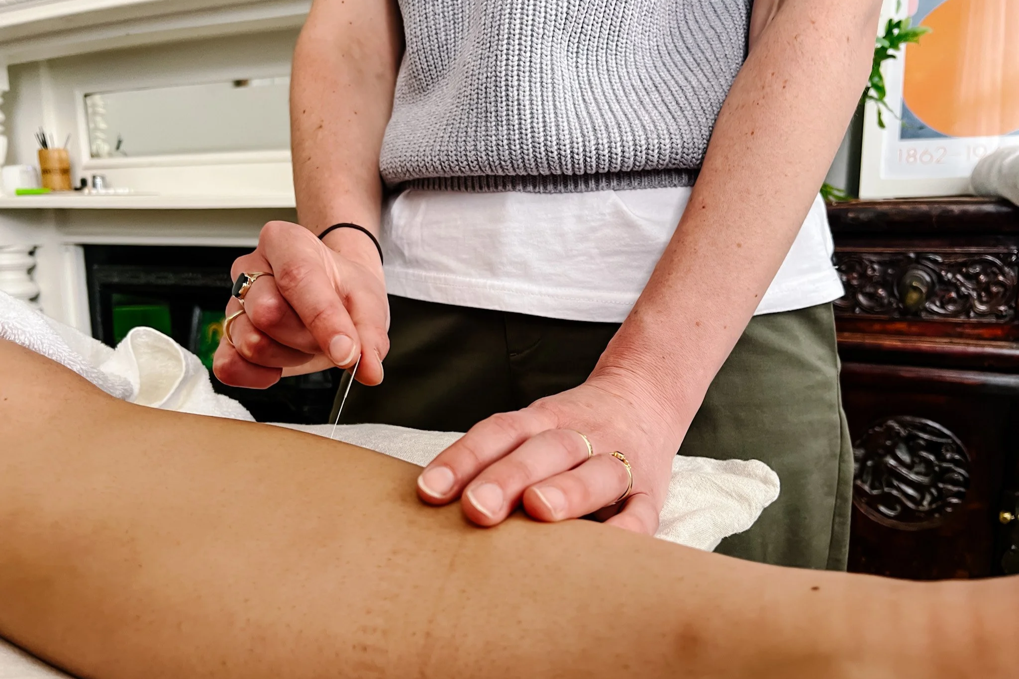 Acupuncture needle in the leg