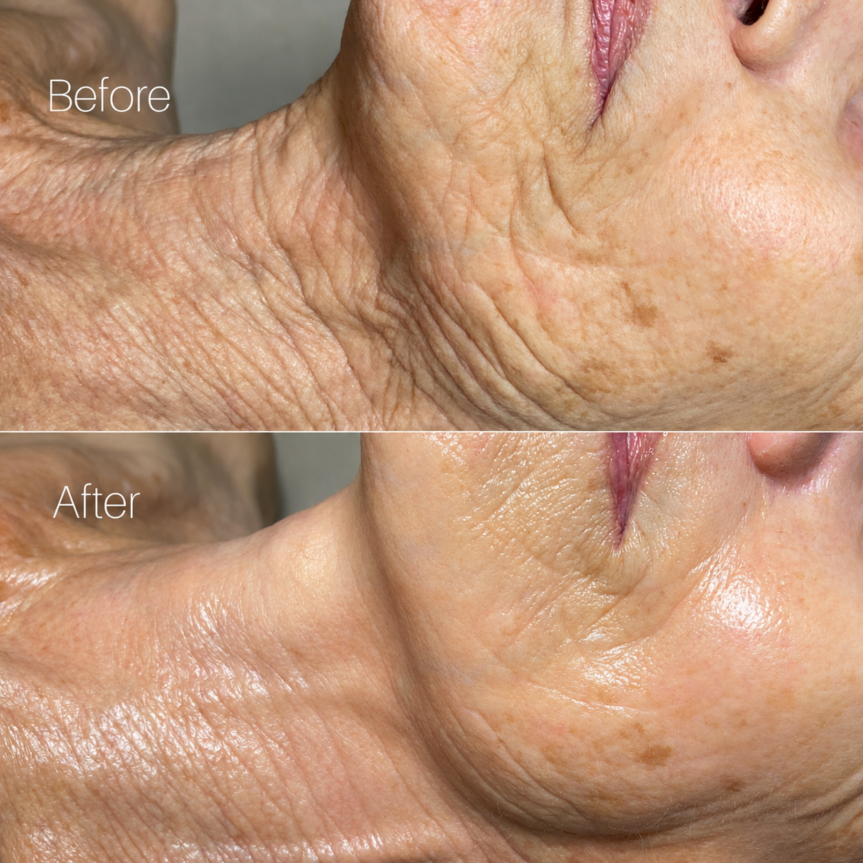 Before and after Signature Custom Facial with electroporation at Wax n' Peels in Monrovia