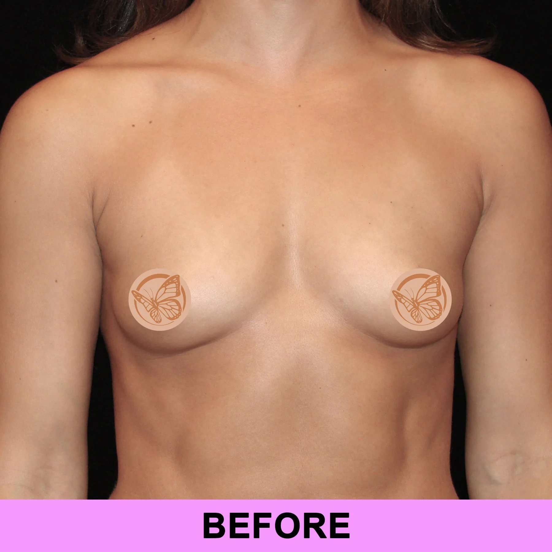 1 before - breastaug.jpg