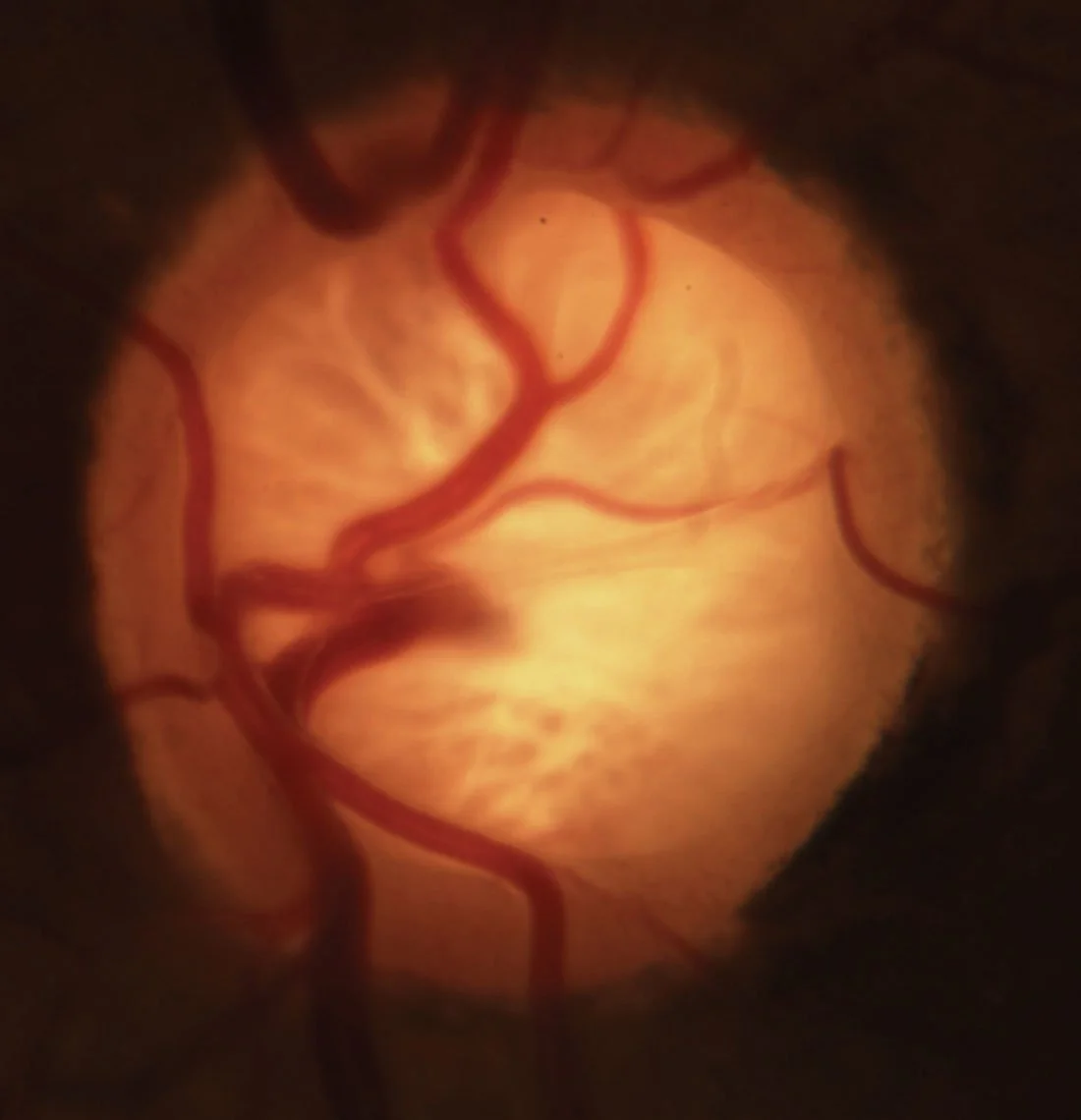August: Glaucoma