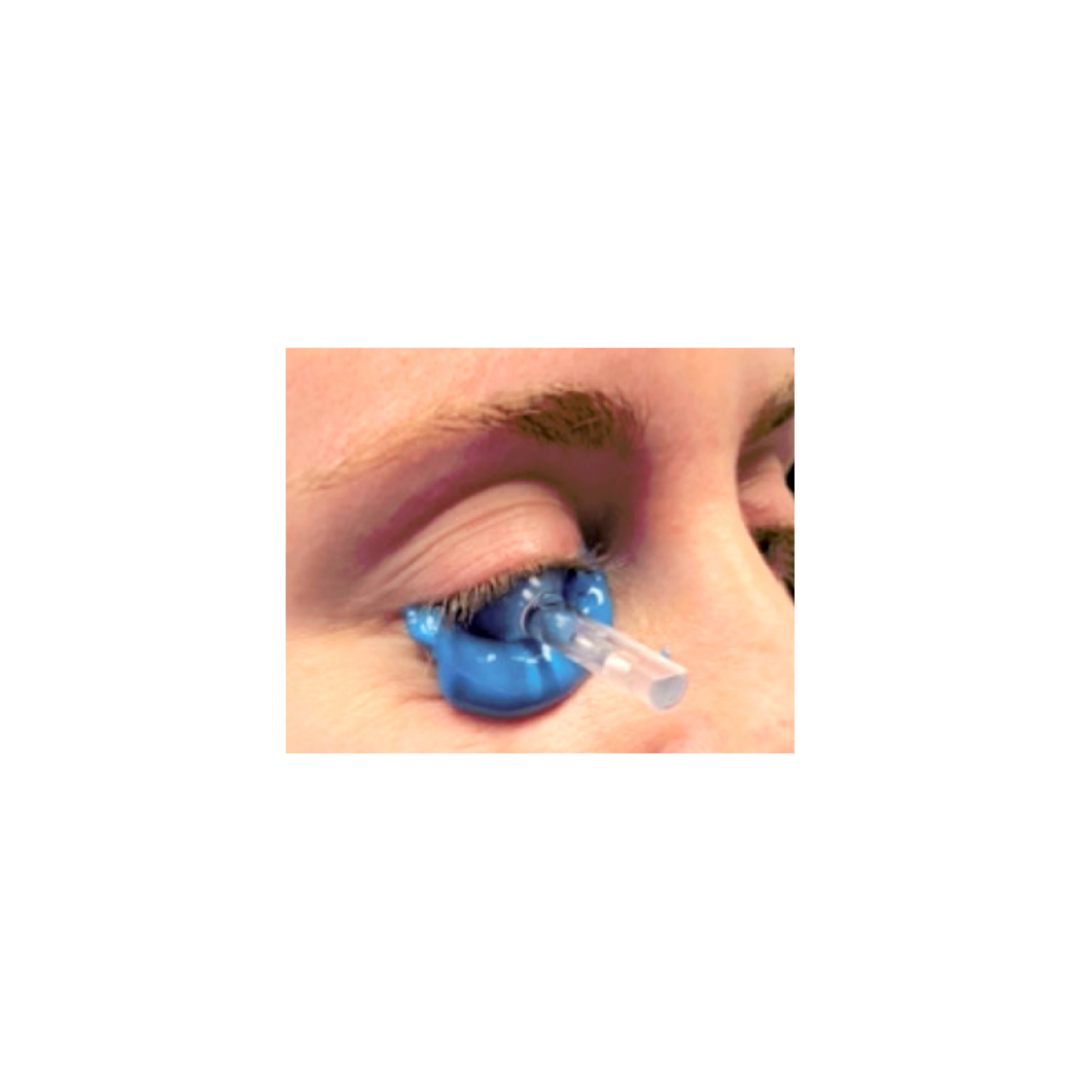 Dr. Kumar is the Medical Science Liaison and Staff Optometrist at EyePrint Prosthetics. Visit Specialty Contact Lens Studio for an impression-based scleral contact lens fit today.