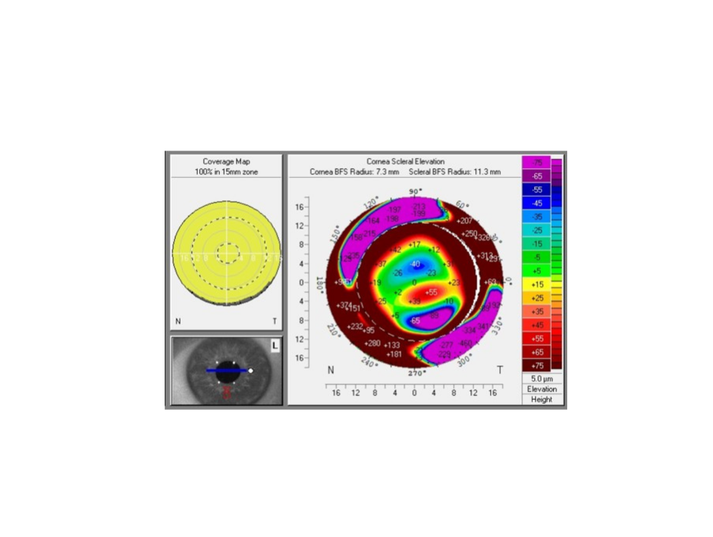 Corneal topography map with color-coded elevation data, a coverage map, and an eye scan, used for eye health analysis.