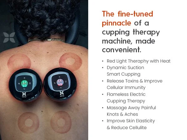 Photo of a person receiving cupping therapy with two smart cups on their upper back, with four circular cupping marks visible on the skin and text listing benefits of the therapy.