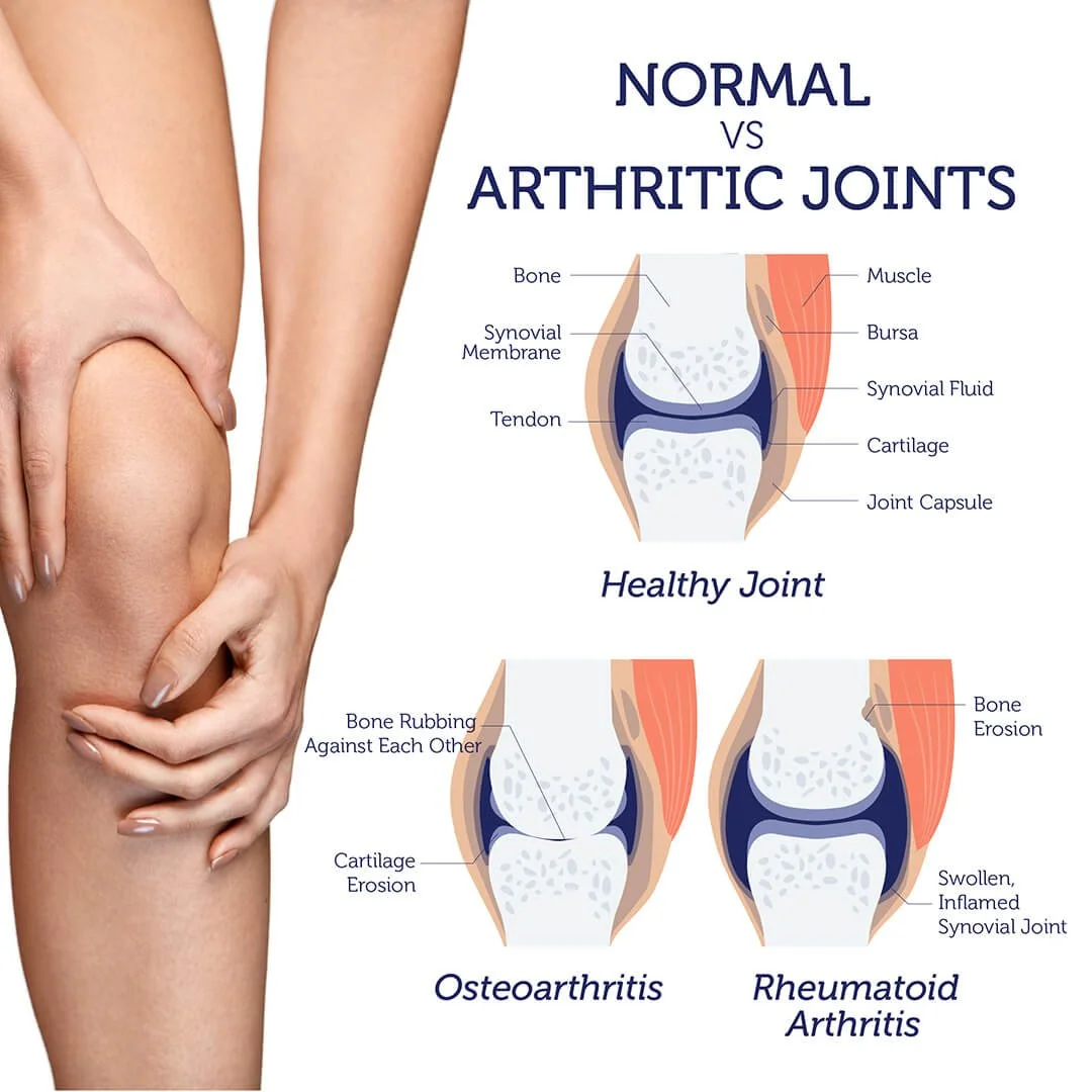 osteoporosis-2.jpg