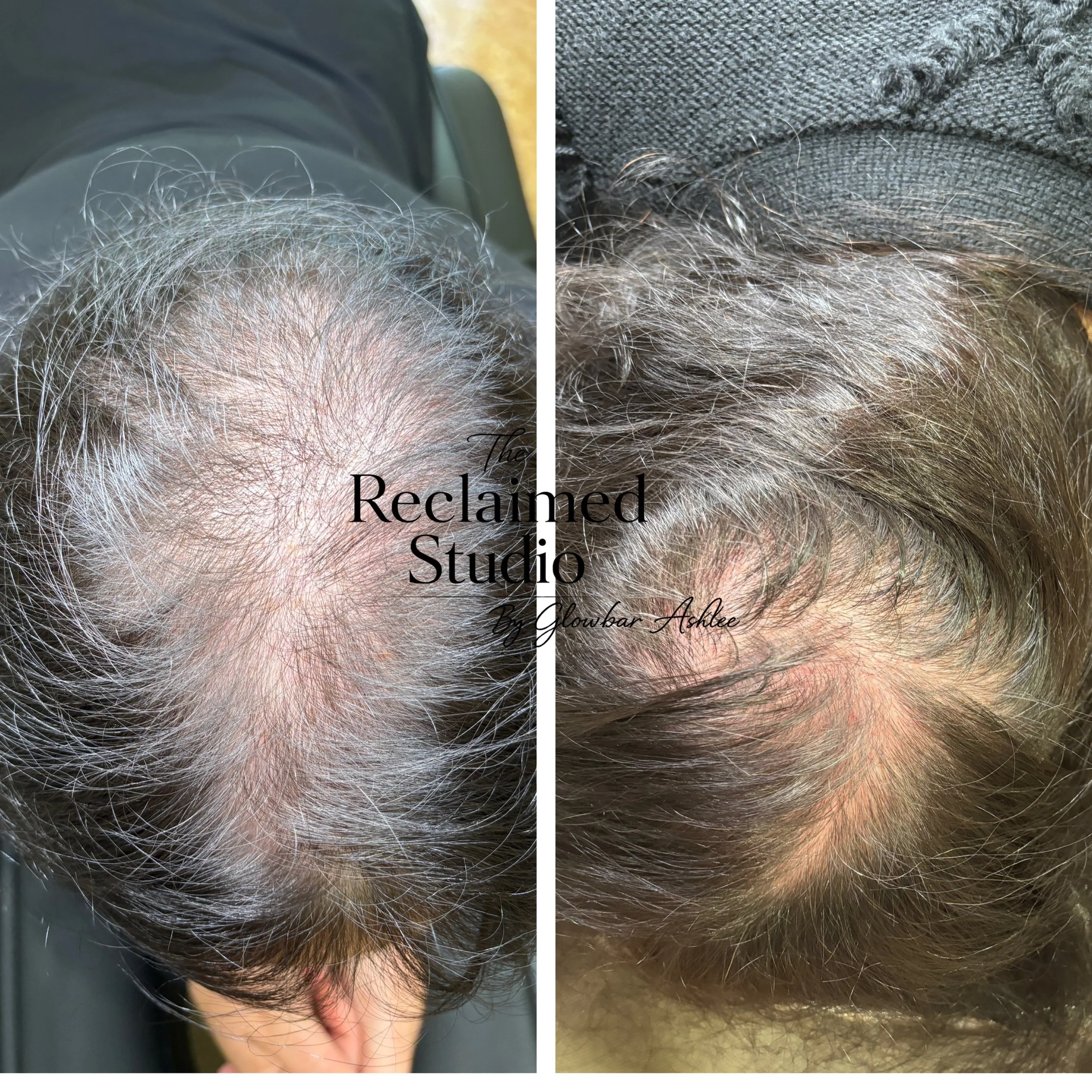 Two sessions of NUE Strand and already huge improvement on hair density. 4 more sessions recommended here. 