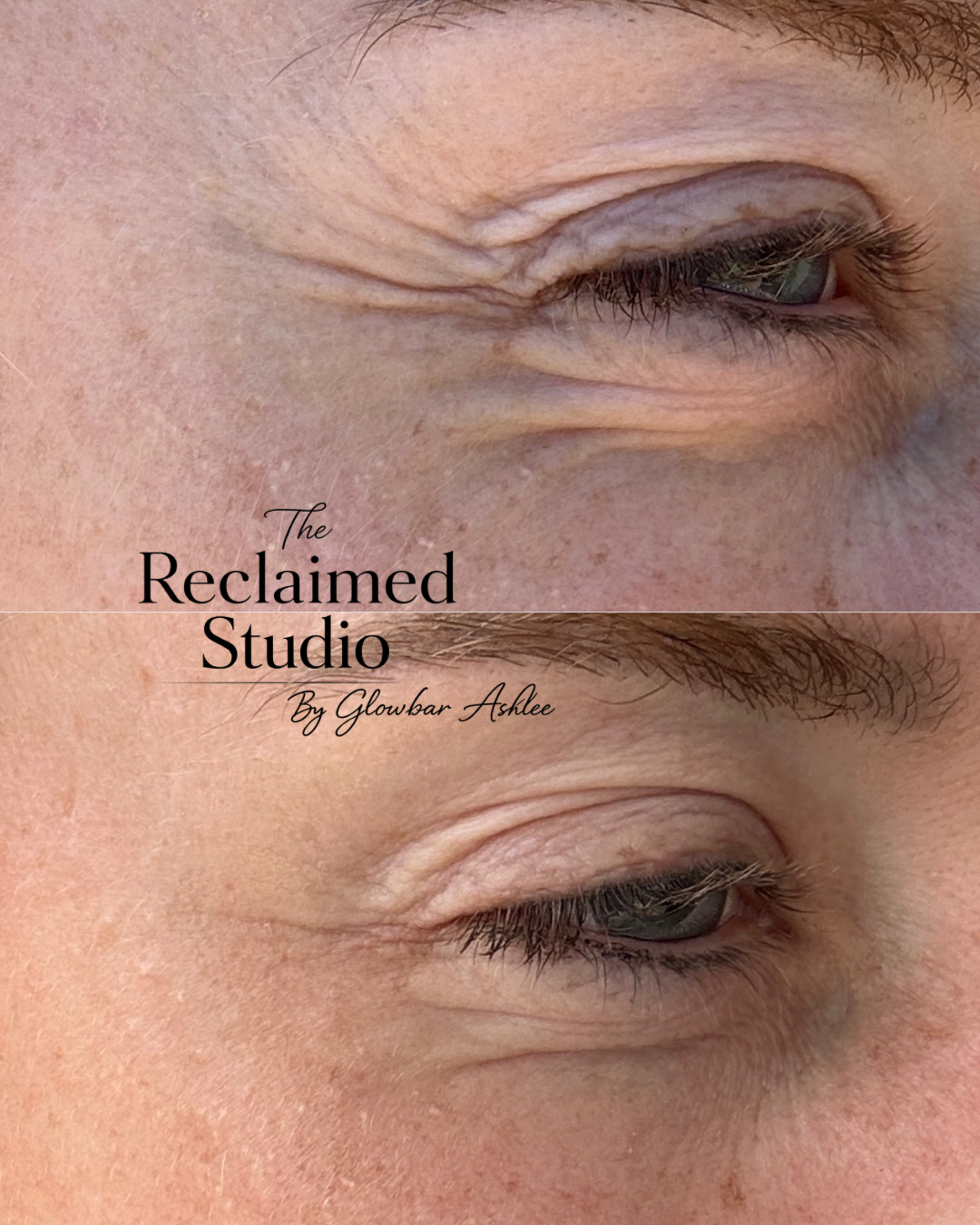 Only one session of inkless revision. Huge improvement of eye texture and elasticity.