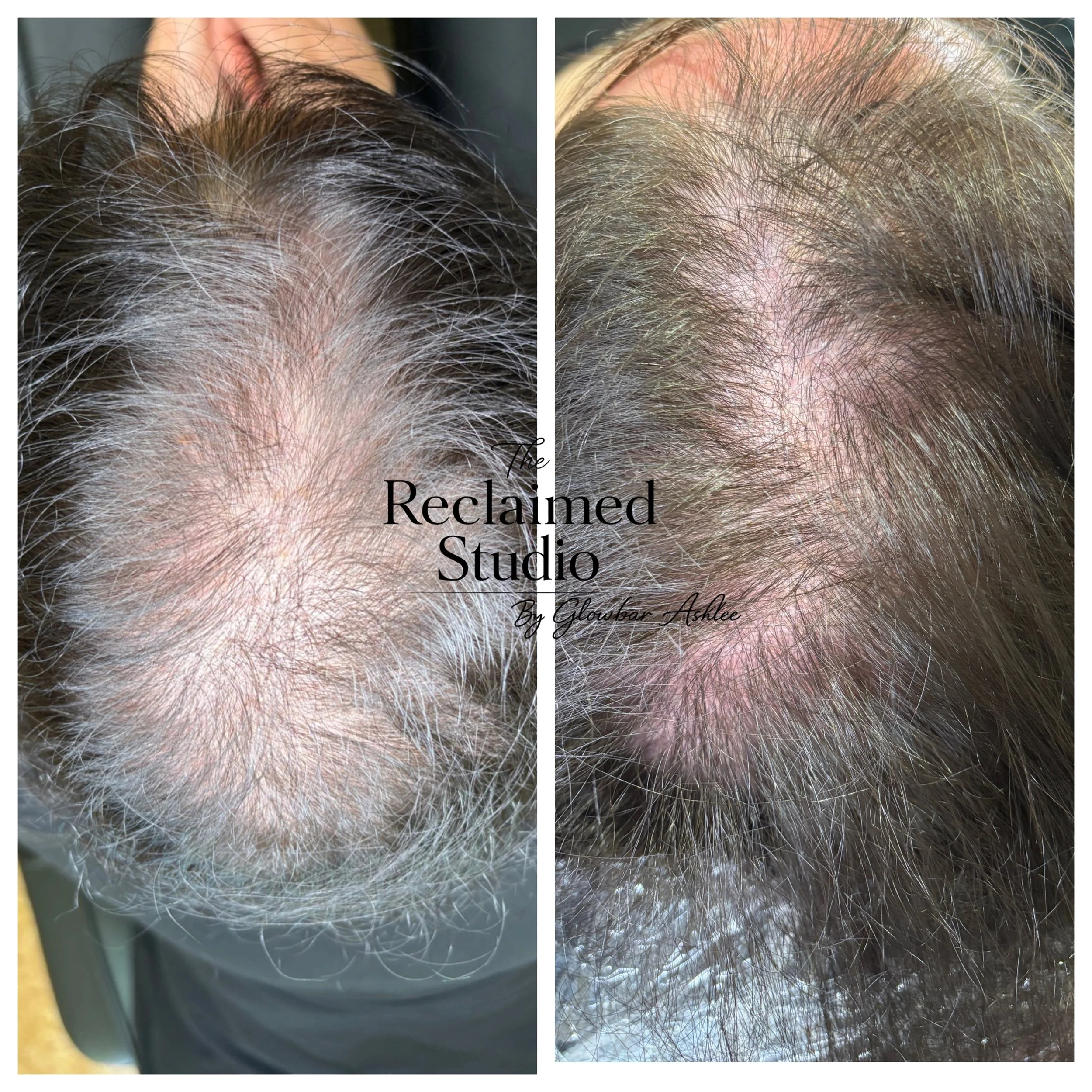 Two sessions of NUE Strand and already huge improvement on hair density. 4 more sessions recommended here