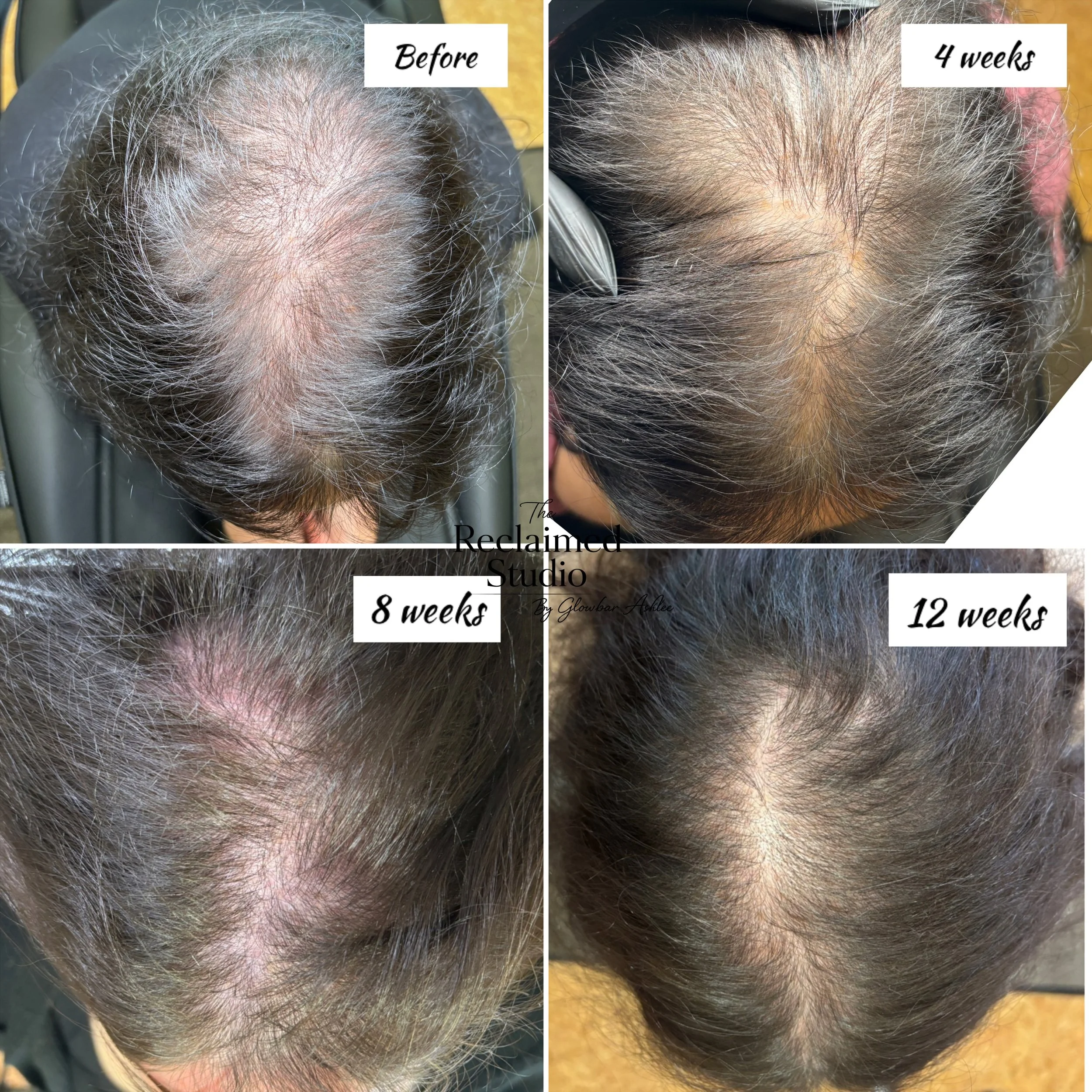 NUE Strand hair regeneration progress. 4 sessions completed with 2 more recommended. Excellent progress so far with real hair growth.