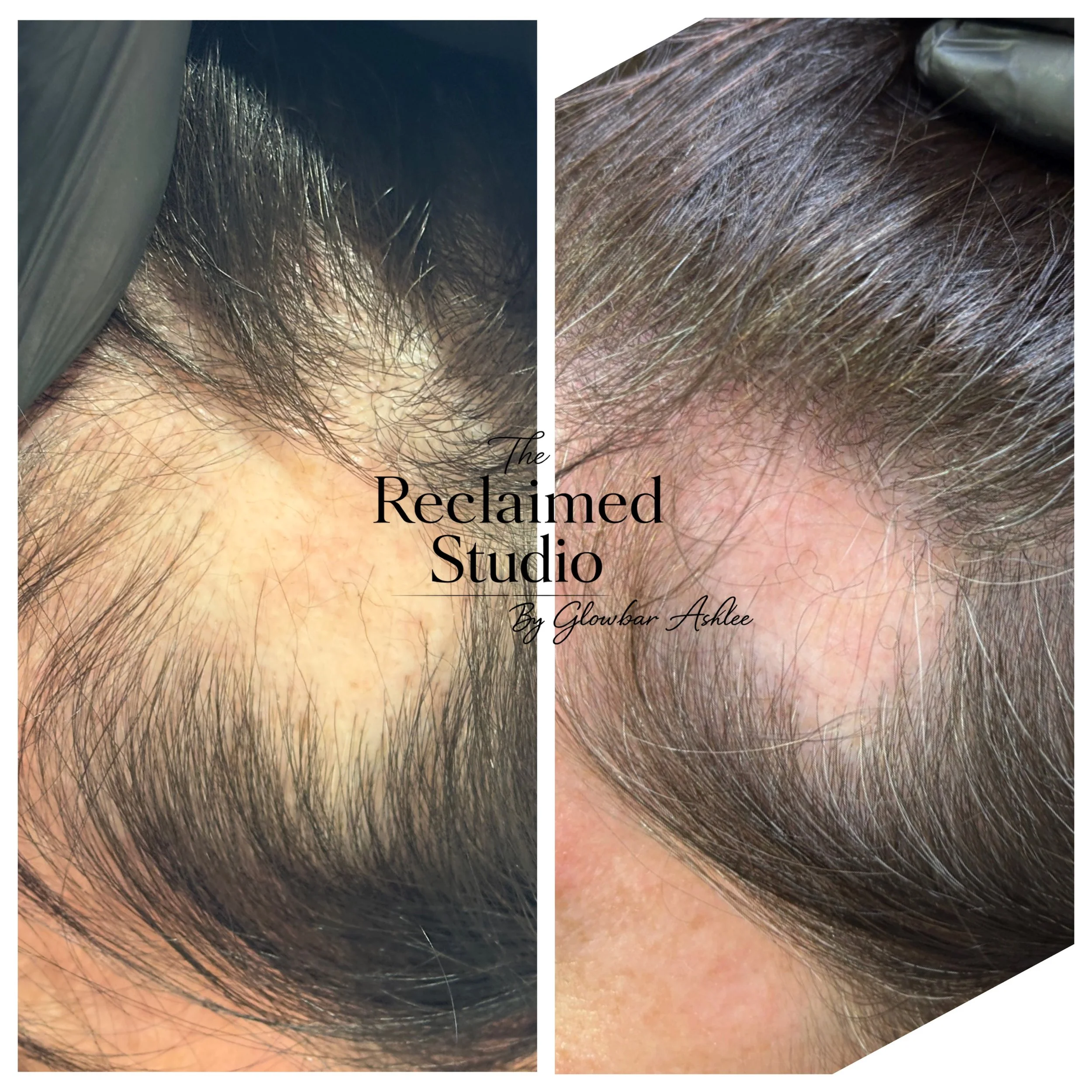 Two sessions of NUE Strand and already huge improvement on hair density. 4 more sessions recommended here. Balding patch is minimising, tho it may not totally regenerate.